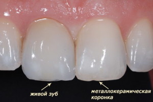 Качество зубов из металлокерамики